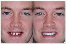Before/After Dental Implants Melrose