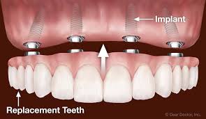 All on 4 Dental Implant Melrose