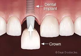 Dental Implant Melrose MA