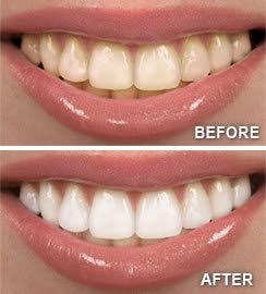 Teeth Whitening Melrose