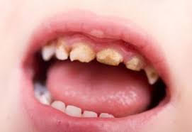 Baby Tooth Decay Treatment in Melrose, MA